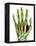 Fractured Palm Bones of Hand, X-ray-Science Photo Library-Framed Premier Image Canvas