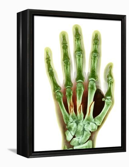 Fractured Palm Bones of Hand, X-ray-Science Photo Library-Framed Premier Image Canvas