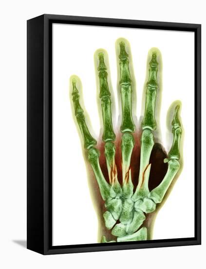 Fractured Palm Bones of Hand, X-ray-Science Photo Library-Framed Premier Image Canvas