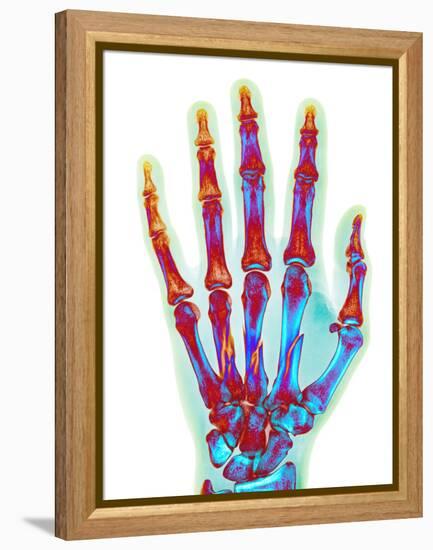 Fractured Palm Bones of Hand, X-ray-Science Photo Library-Framed Premier Image Canvas