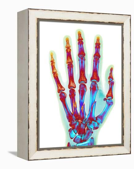 Fractured Palm Bones of Hand, X-ray-Science Photo Library-Framed Premier Image Canvas