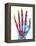 Fractured Palm Bones of Hand, X-ray-Science Photo Library-Framed Premier Image Canvas