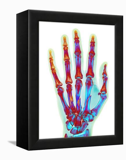 Fractured Palm Bones of Hand, X-ray-Science Photo Library-Framed Premier Image Canvas