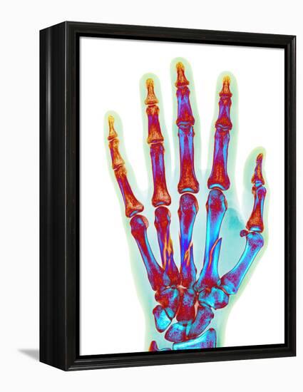 Fractured Palm Bones of Hand, X-ray-Science Photo Library-Framed Premier Image Canvas