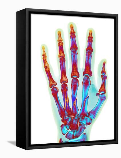 Fractured Palm Bones of Hand, X-ray-Science Photo Library-Framed Premier Image Canvas