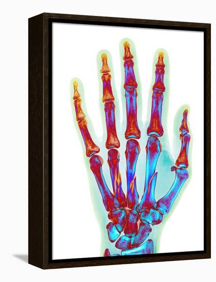 Fractured Palm Bones of Hand, X-ray-Science Photo Library-Framed Premier Image Canvas