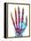 Fractured Palm Bones of Hand, X-ray-Science Photo Library-Framed Premier Image Canvas