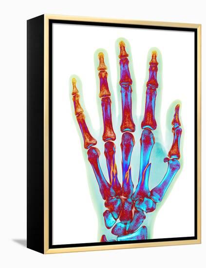 Fractured Palm Bones of Hand, X-ray-Science Photo Library-Framed Premier Image Canvas