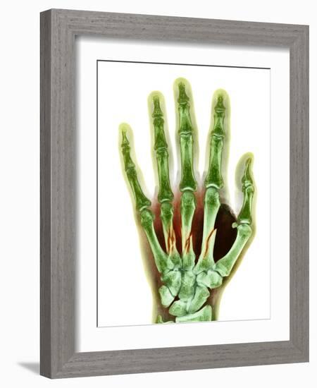 Fractured Palm Bones of Hand, X-ray-Science Photo Library-Framed Photographic Print