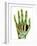 Fractured Palm Bones of Hand, X-ray-Science Photo Library-Framed Photographic Print