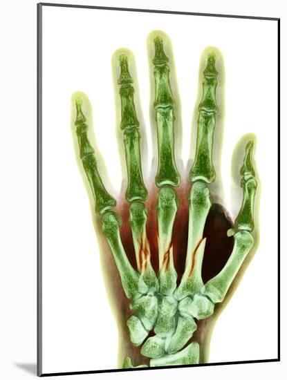 Fractured Palm Bones of Hand, X-ray-Science Photo Library-Mounted Photographic Print