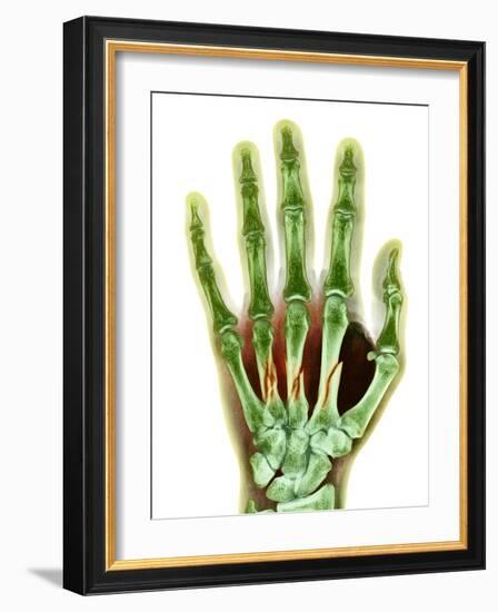 Fractured Palm Bones of Hand, X-ray-Science Photo Library-Framed Photographic Print