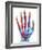 Fractured Palm Bones of Hand, X-ray-Science Photo Library-Framed Photographic Print