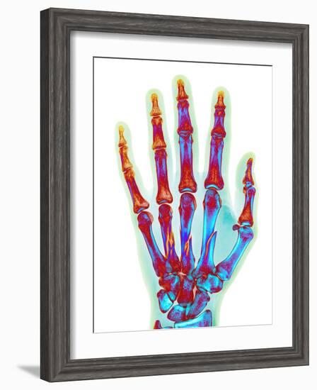 Fractured Palm Bones of Hand, X-ray-Science Photo Library-Framed Photographic Print