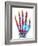 Fractured Palm Bones of Hand, X-ray-Science Photo Library-Framed Photographic Print