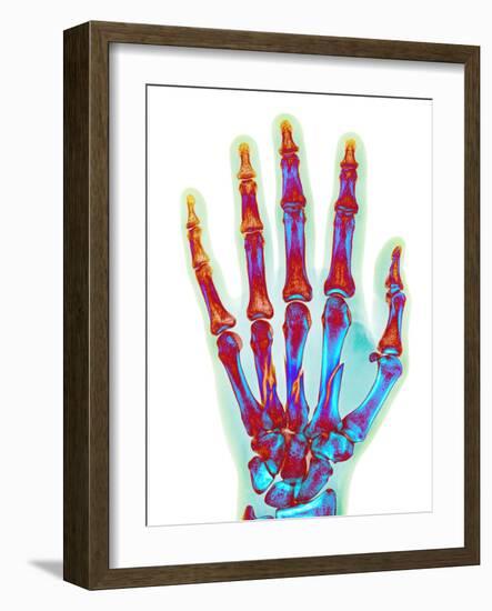 Fractured Palm Bones of Hand, X-ray-Science Photo Library-Framed Photographic Print