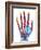 Fractured Palm Bones of Hand, X-ray-Science Photo Library-Framed Photographic Print