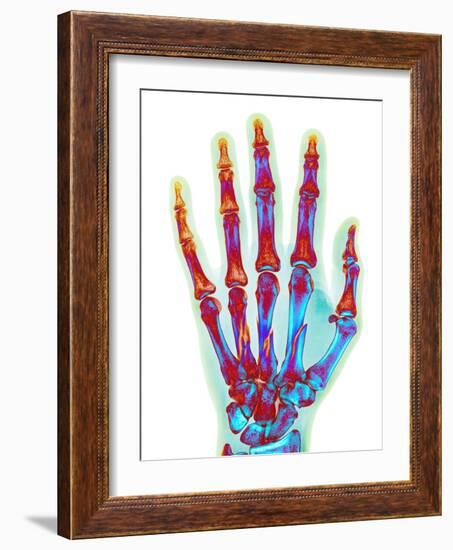 Fractured Palm Bones of Hand, X-ray-Science Photo Library-Framed Photographic Print