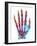 Fractured Palm Bones of Hand, X-ray-Science Photo Library-Framed Photographic Print