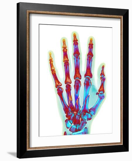 Fractured Palm Bones of Hand, X-ray-Science Photo Library-Framed Photographic Print