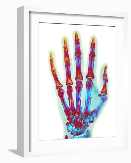 Fractured Palm Bones of Hand, X-ray-Science Photo Library-Framed Photographic Print