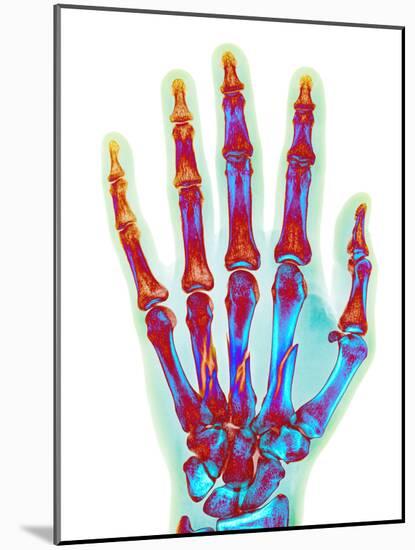 Fractured Palm Bones of Hand, X-ray-Science Photo Library-Mounted Photographic Print