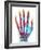 Fractured Palm Bones of Hand, X-ray-Science Photo Library-Framed Photographic Print