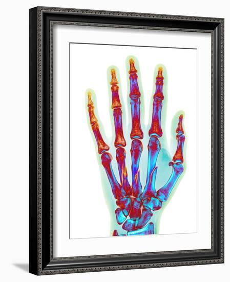 Fractured Palm Bones of Hand, X-ray-Science Photo Library-Framed Photographic Print