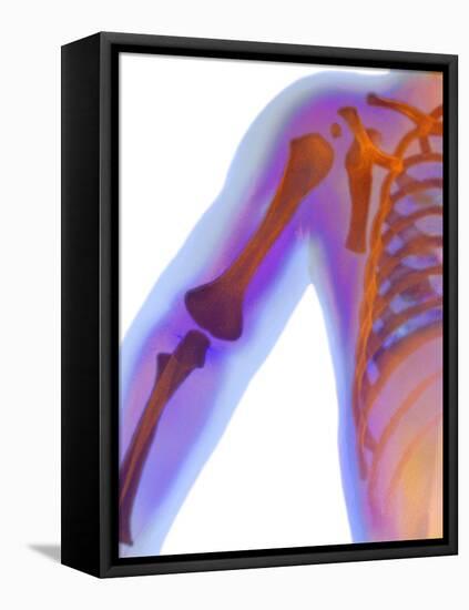 Fractured Shoulder, X-ray-Du Cane Medical-Framed Premier Image Canvas