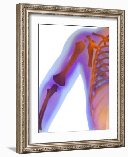 Fractured Shoulder, X-ray-Du Cane Medical-Framed Photographic Print