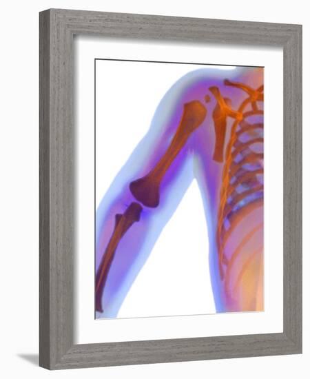 Fractured Shoulder, X-ray-Du Cane Medical-Framed Photographic Print