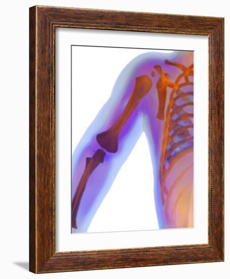 Fractured Shoulder, X-ray-Du Cane Medical-Framed Photographic Print