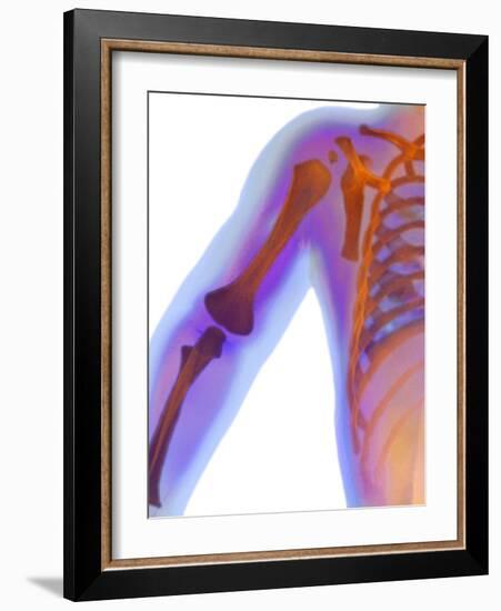 Fractured Shoulder, X-ray-Du Cane Medical-Framed Photographic Print