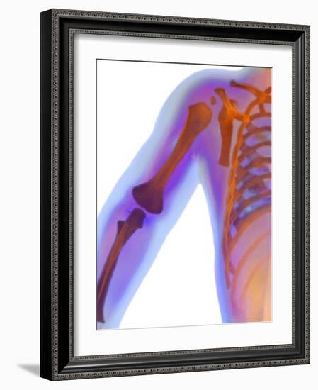 Fractured Shoulder, X-ray-Du Cane Medical-Framed Photographic Print