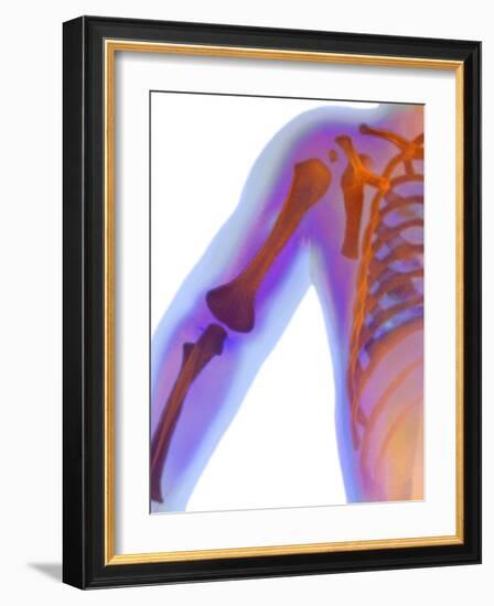 Fractured Shoulder, X-ray-Du Cane Medical-Framed Photographic Print