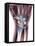 Fractured Wrist, X-ray-Du Cane Medical-Framed Premier Image Canvas