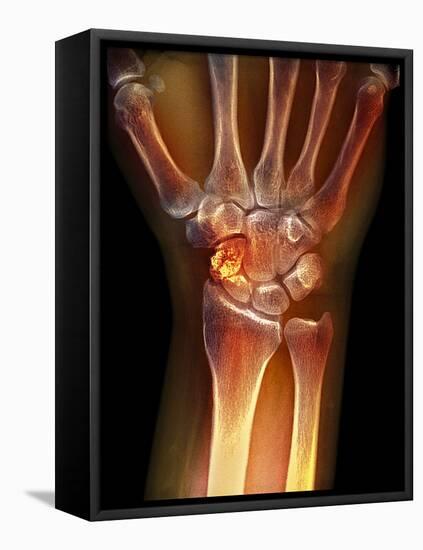 Fractured Wrist, X-ray-Du Cane Medical-Framed Premier Image Canvas