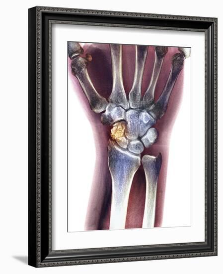 Fractured Wrist, X-ray-Du Cane Medical-Framed Photographic Print