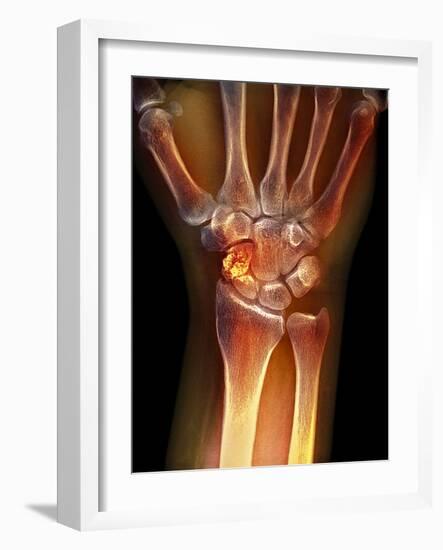 Fractured Wrist, X-ray-Du Cane Medical-Framed Photographic Print