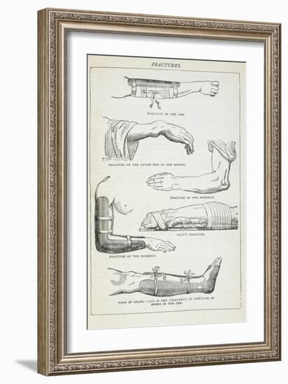 Fractures and Methods Of Bandaging.-Isabella Beeton-Framed Giclee Print