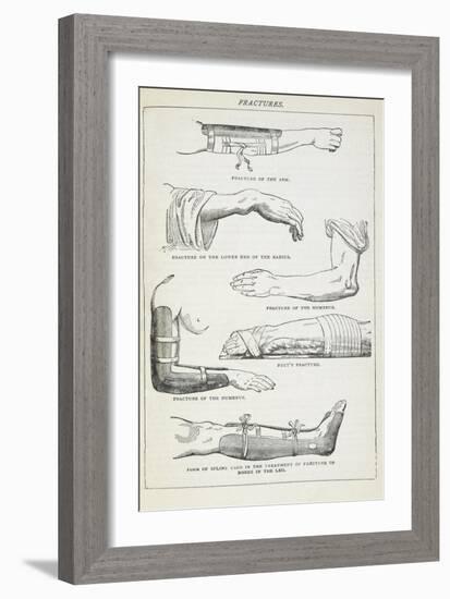 Fractures and Methods Of Bandaging.-Isabella Beeton-Framed Giclee Print