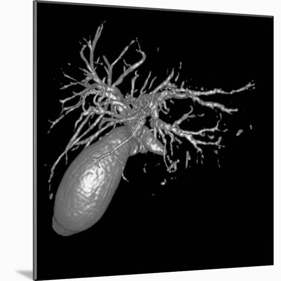 Gallbladder And Biliary Tree, 3D MRI-Du Cane Medical-Mounted Photographic Print