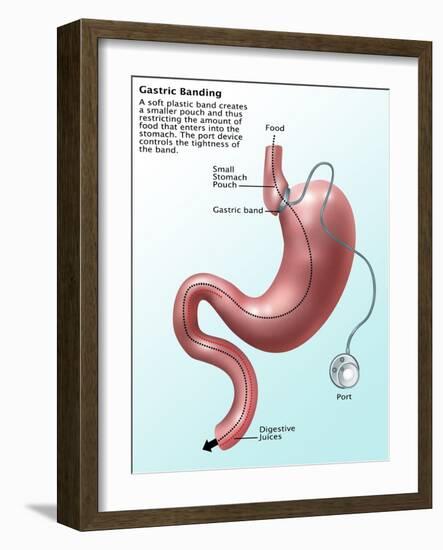 Gastric Banding-Gwen Shockey-Framed Giclee Print