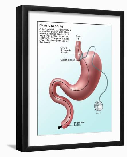 Gastric Banding-Gwen Shockey-Framed Giclee Print