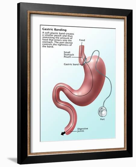 Gastric Banding-Gwen Shockey-Framed Giclee Print