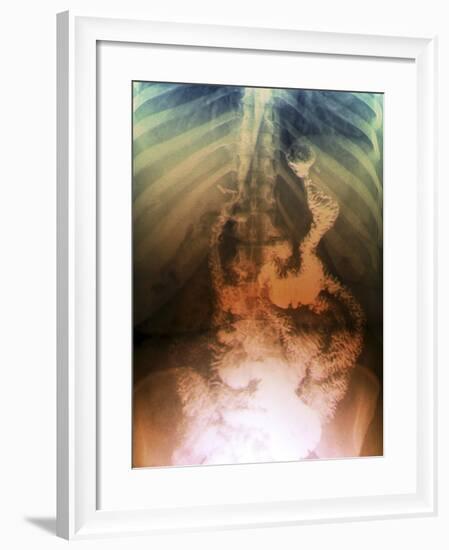 Gastric Bypass Surgery, X-ray-ZEPHYR-Framed Photographic Print