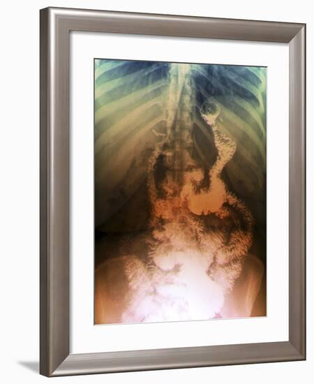 Gastric Bypass Surgery, X-ray-ZEPHYR-Framed Photographic Print