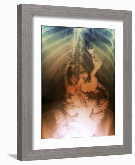 Gastric Bypass Surgery, X-ray-ZEPHYR-Framed Photographic Print