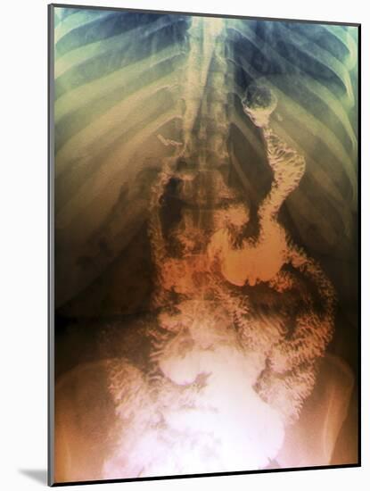 Gastric Bypass Surgery, X-ray-ZEPHYR-Mounted Photographic Print