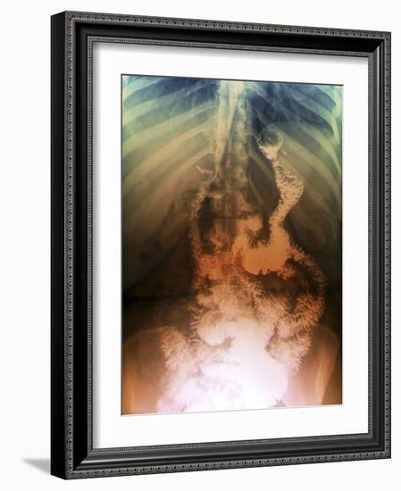 Gastric Bypass Surgery, X-ray-ZEPHYR-Framed Photographic Print